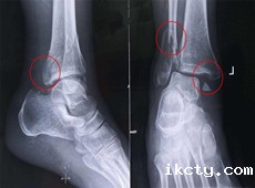 【医疗科普】踝关节骨折的主要类型及其影像学表现