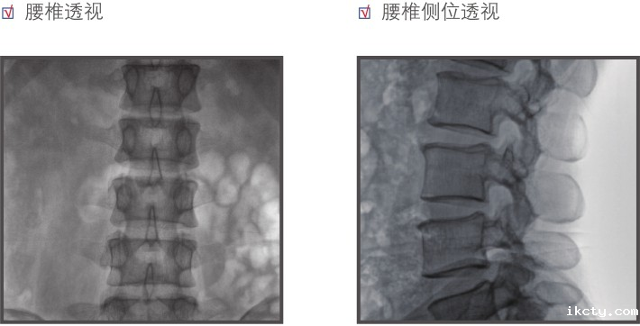 平板小C腰椎成像效果