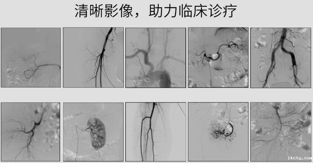 介入c臂机高清影像