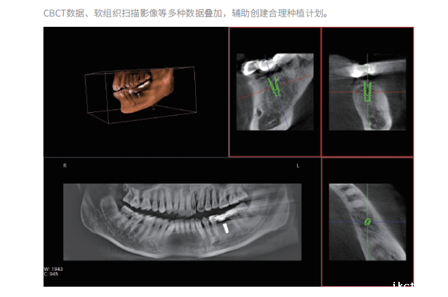 大视野口腔CBCT影像