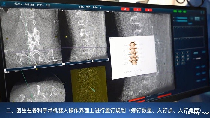 骨科手术机器人和医生分工2
