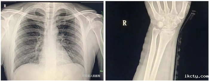 动态DR影像