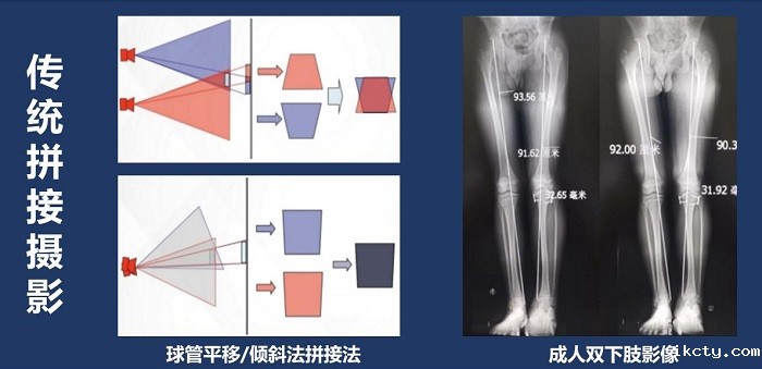 长骨拼接技术拍摄全脊柱X光片